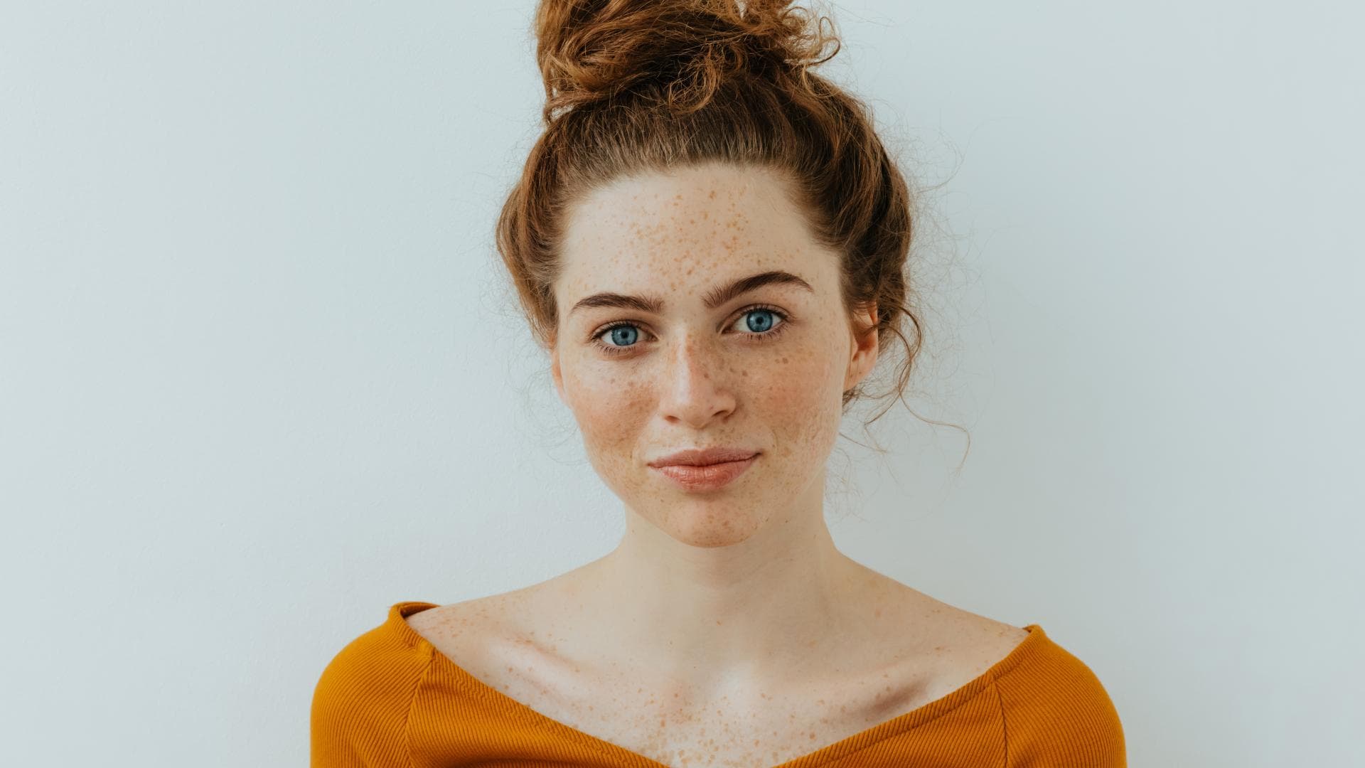 Pigmentflecken im Gesicht einer jungen Frau