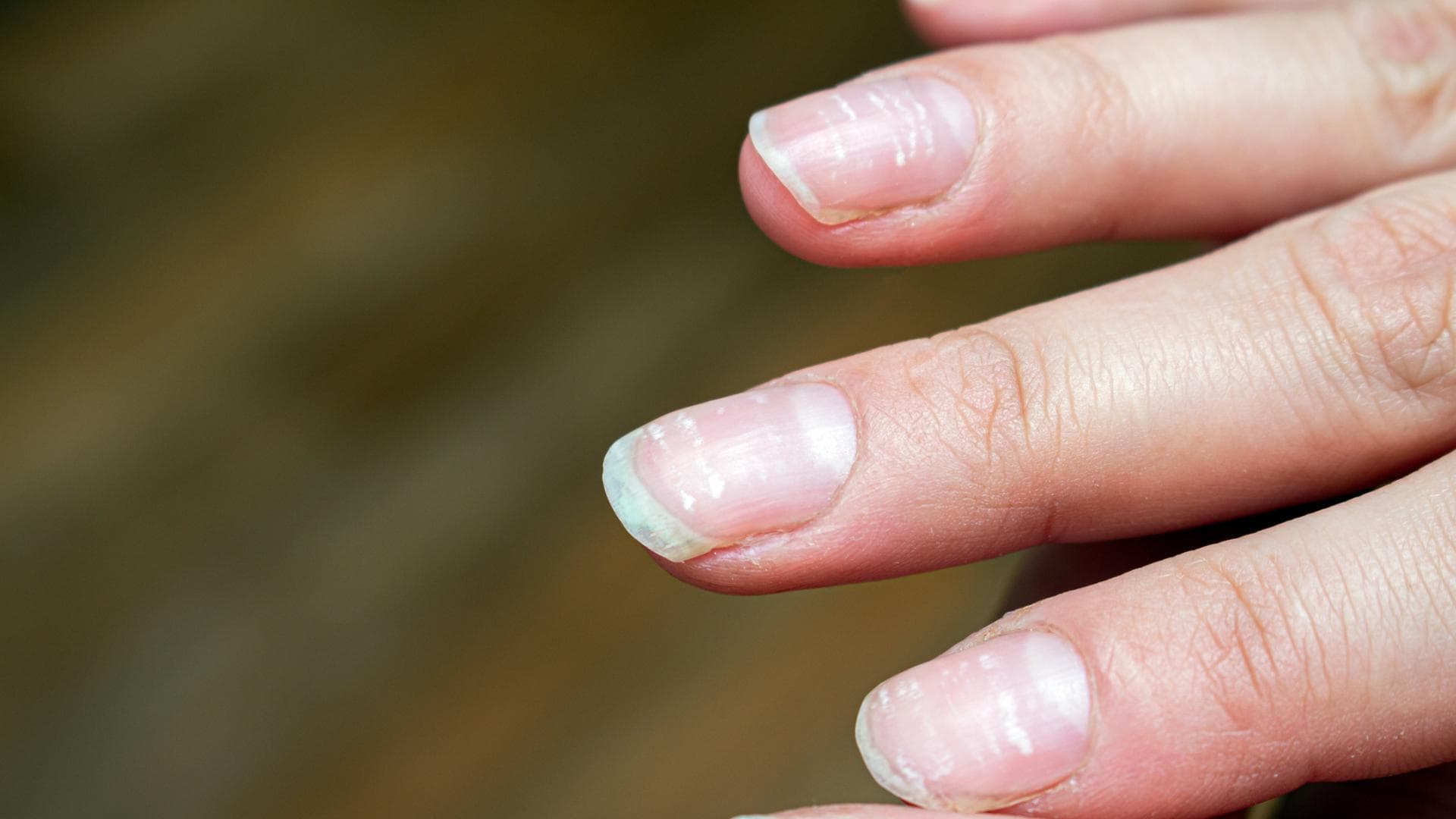 Weiße Flecken Fingernägel