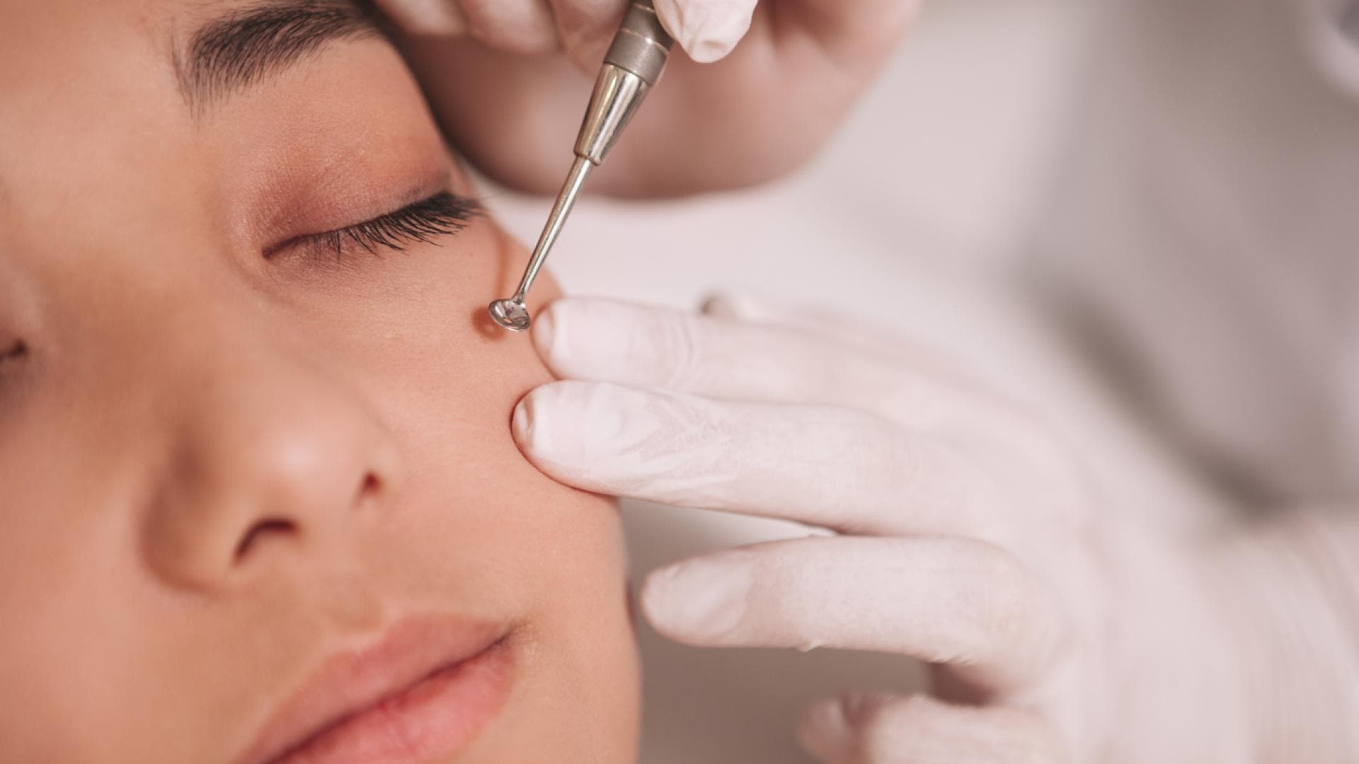 Komedonenquetscher Behandlung