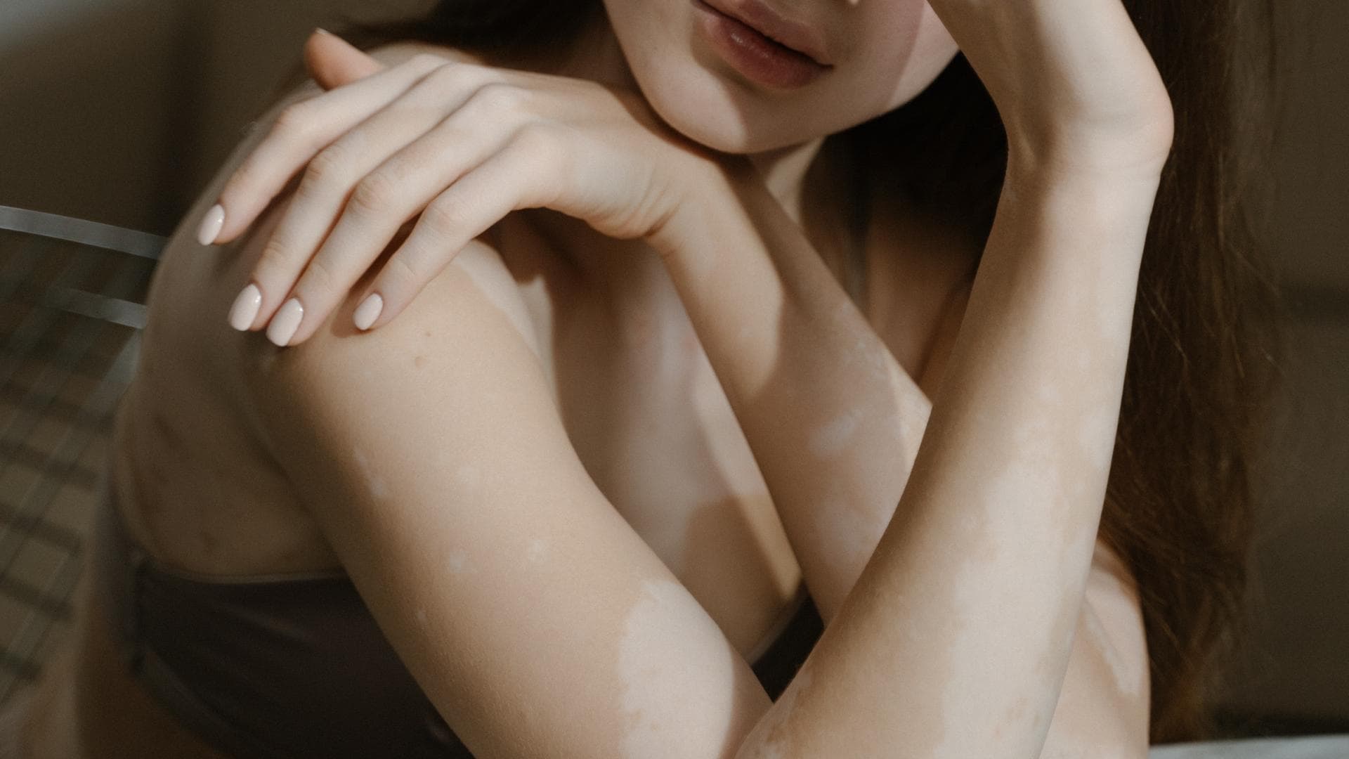 Frau mit Vitiligo