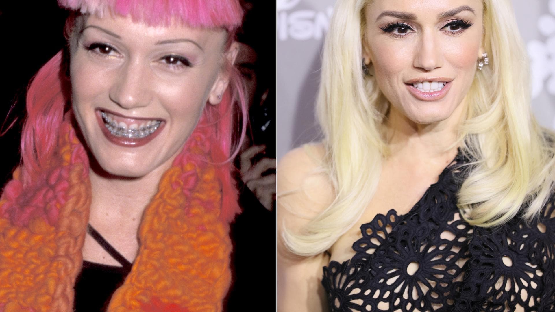 Stars mit festen Zahnspangen