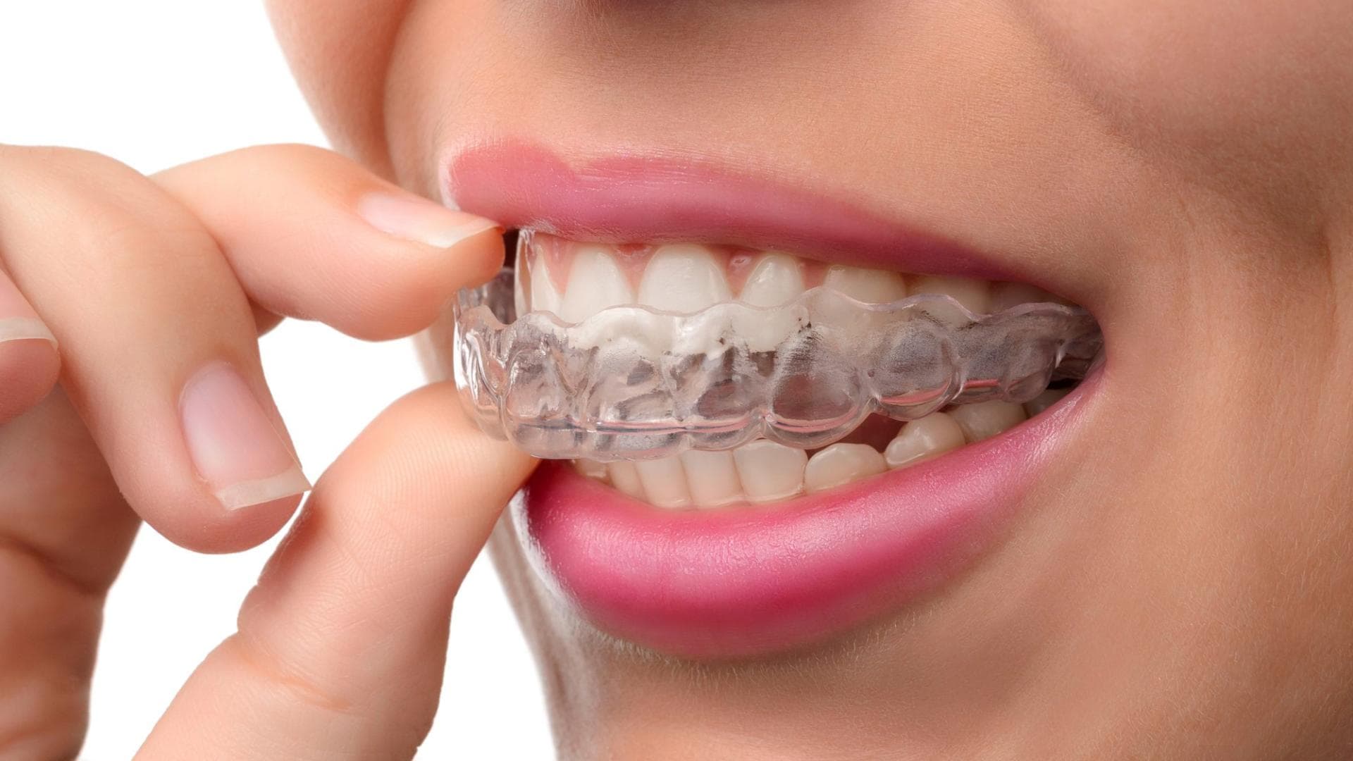 Invisalign