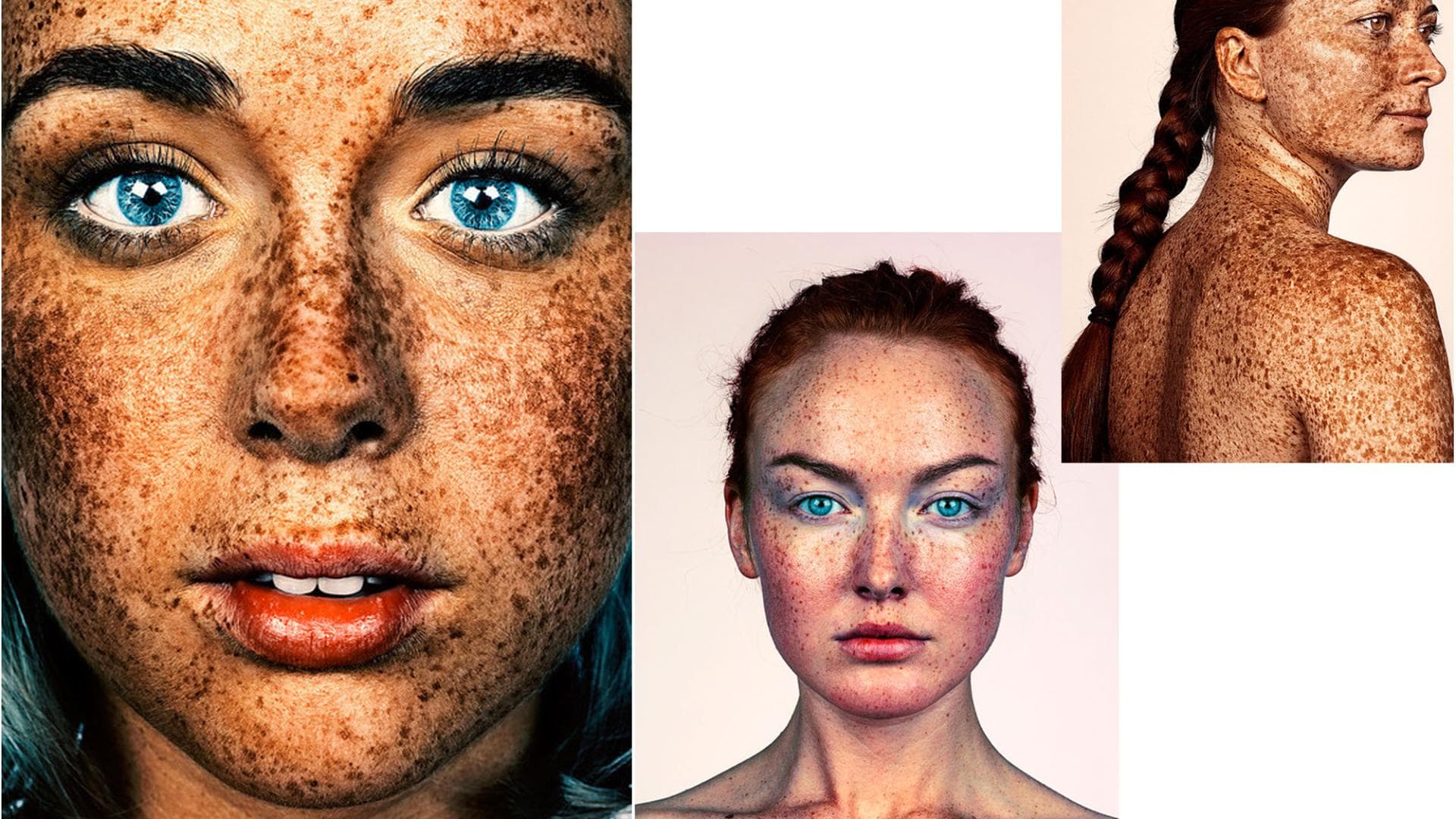 Sommersprossen Brock Elbank