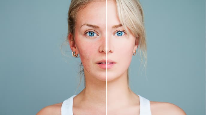 Junge Frau mit Rosacea und gesunder Haut, das Bild ist in der Mitte geteilt