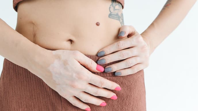 Was hilft gegen Narben: Frau mit Narbe neben dem Bauchnabel