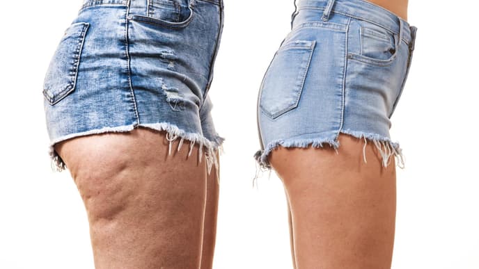 Instagram: Zwei verschiedene Beine in Shorts