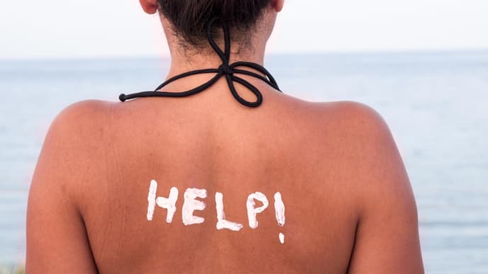 Frau mit Sonnenbrand