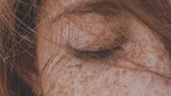 Sommersprossen im Gesicht