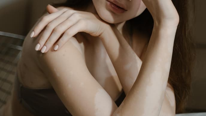 Frau mit Vitiligo