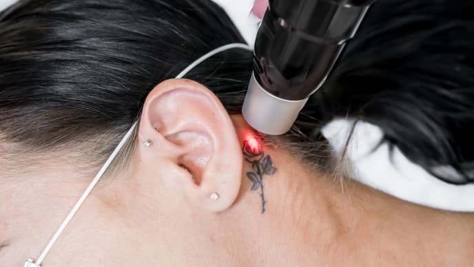 Tatto hinter dem Ohr wird gelasert