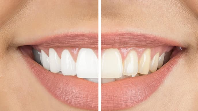 Bleaching: Vergleich vorher nachher