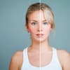 Junge Frau mit Rosacea und gesunder Haut, das Bild ist in der Mitte geteilt