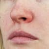Pickel in der Nase