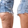 Instagram: Zwei verschiedene Beine in Shorts