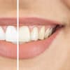 Bleaching: Vergleich vorher nachher