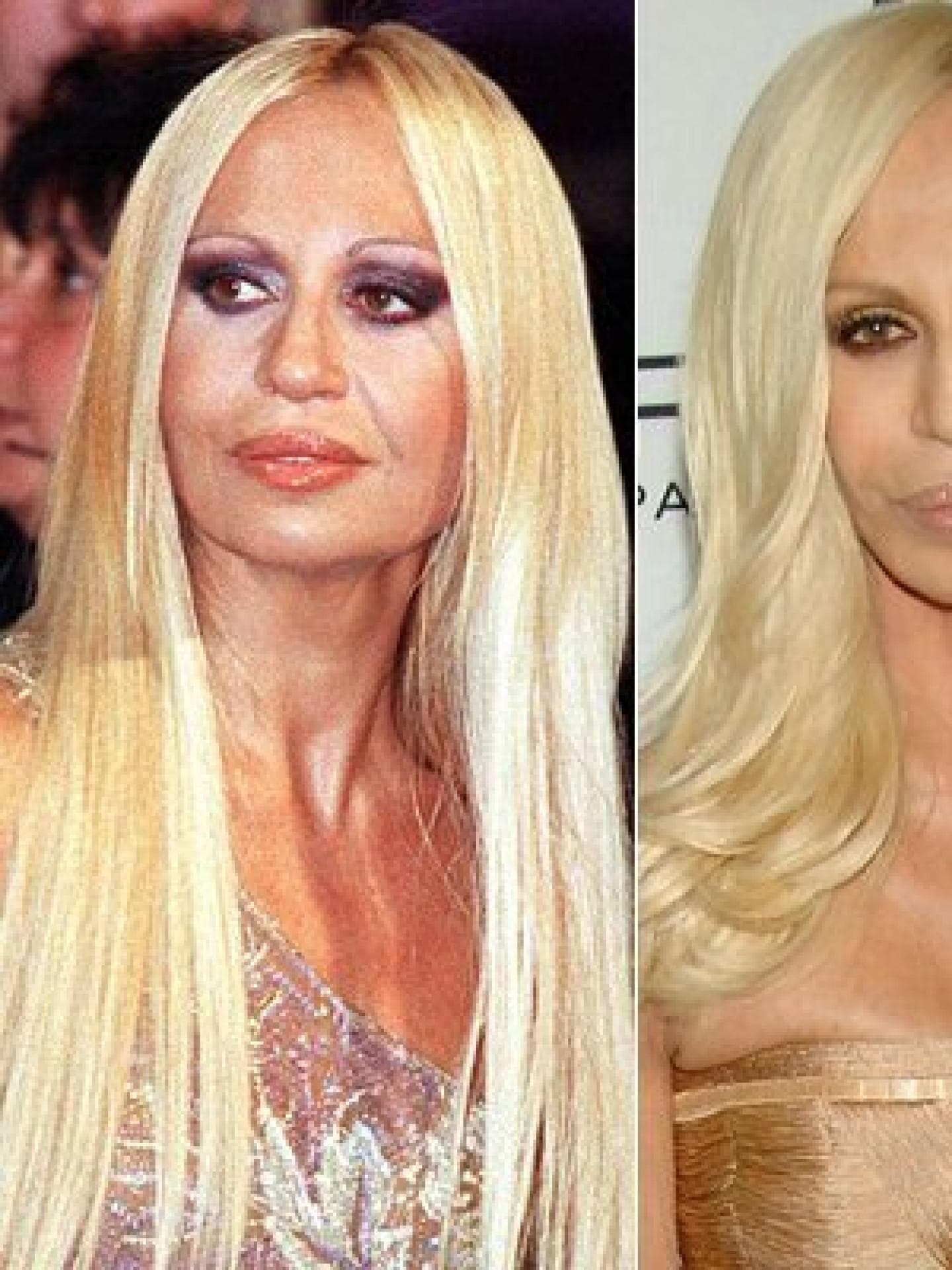 Donatella Versace: Vorher-Nachher Donatella Versace: Vorher-Nachher