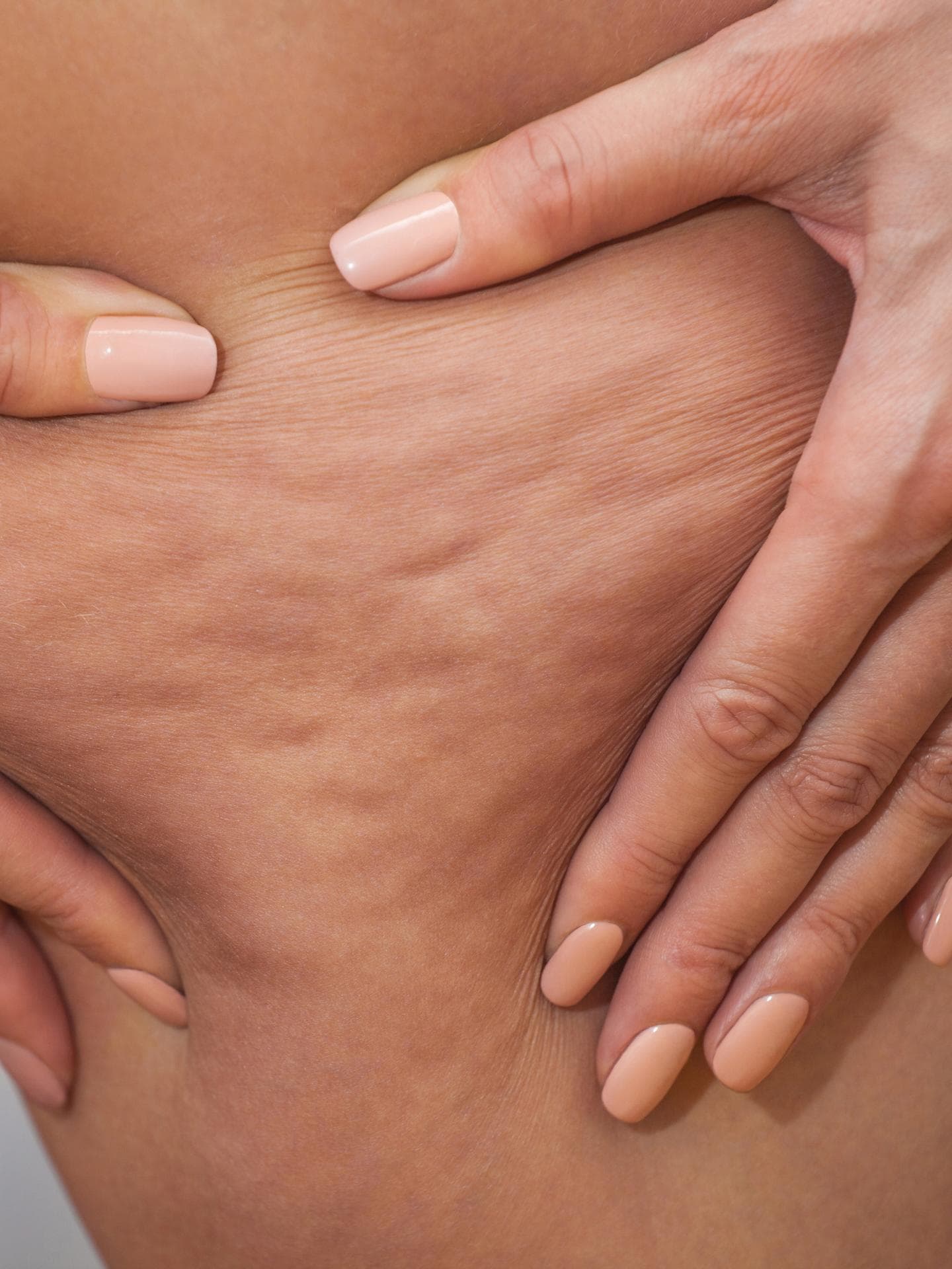 Körperliche Veränderungen in der Schwangerschaft: Entstehende oder verstärkte Cellulite Körperliche Veränderungen in der Schwangerschaft: Entstehende oder verstärkte Cellulite