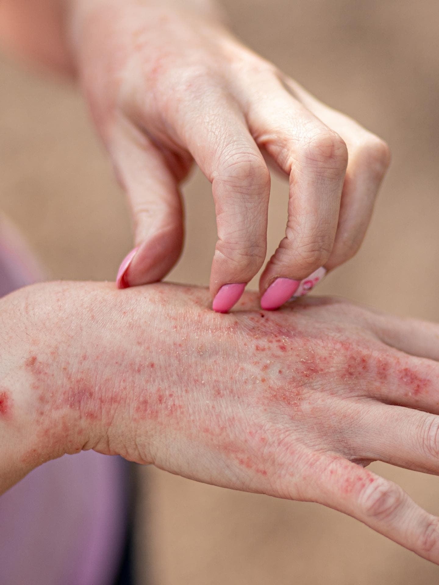 Rotes Ekzem auf Hand