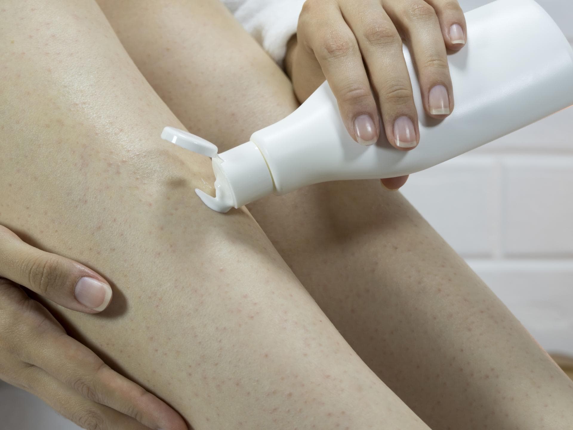 Reibeisenhaut (Keratosis Pilaris) eincremen