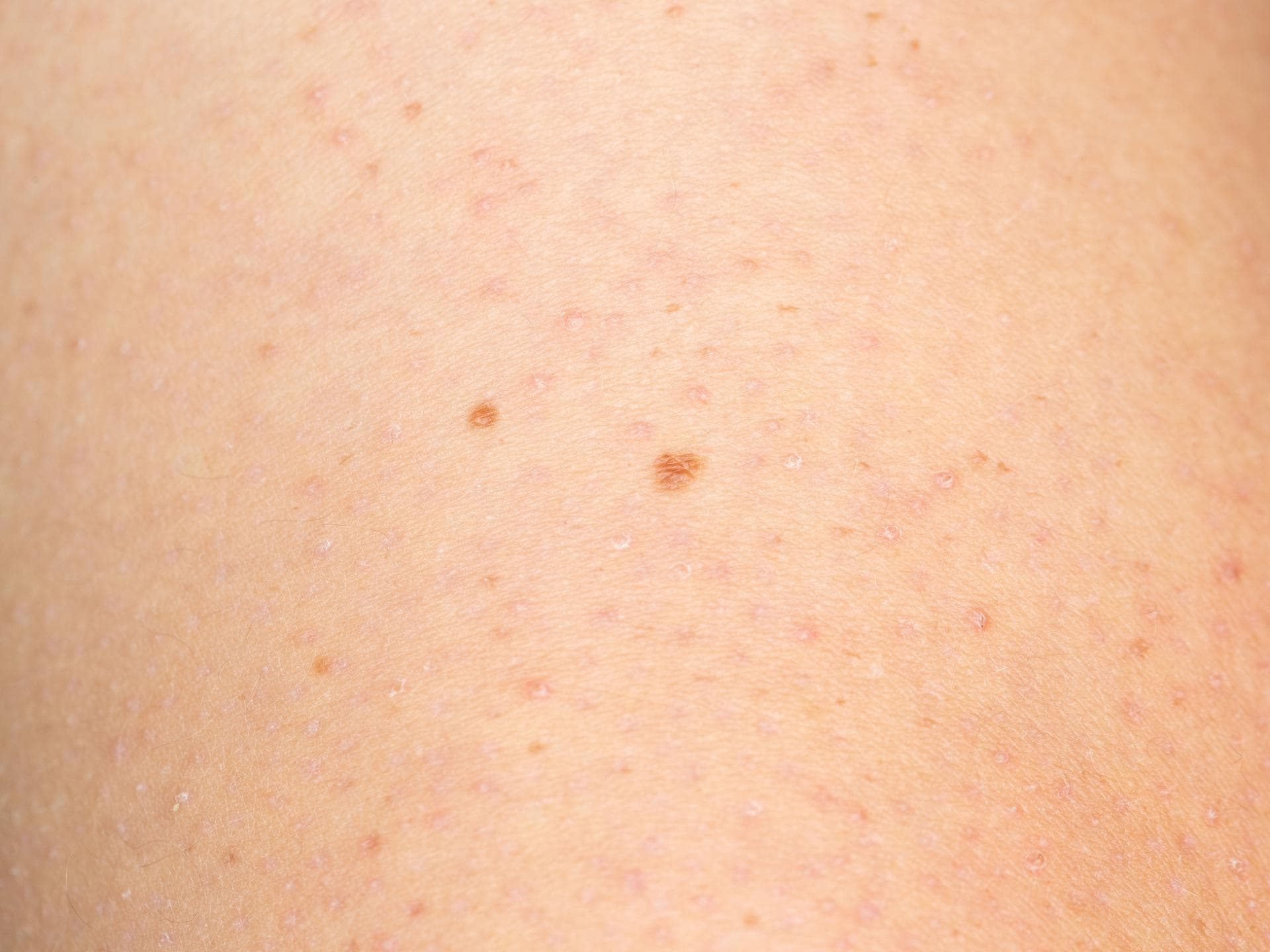 Reibeisenhaut (Keratosis Pilaris)