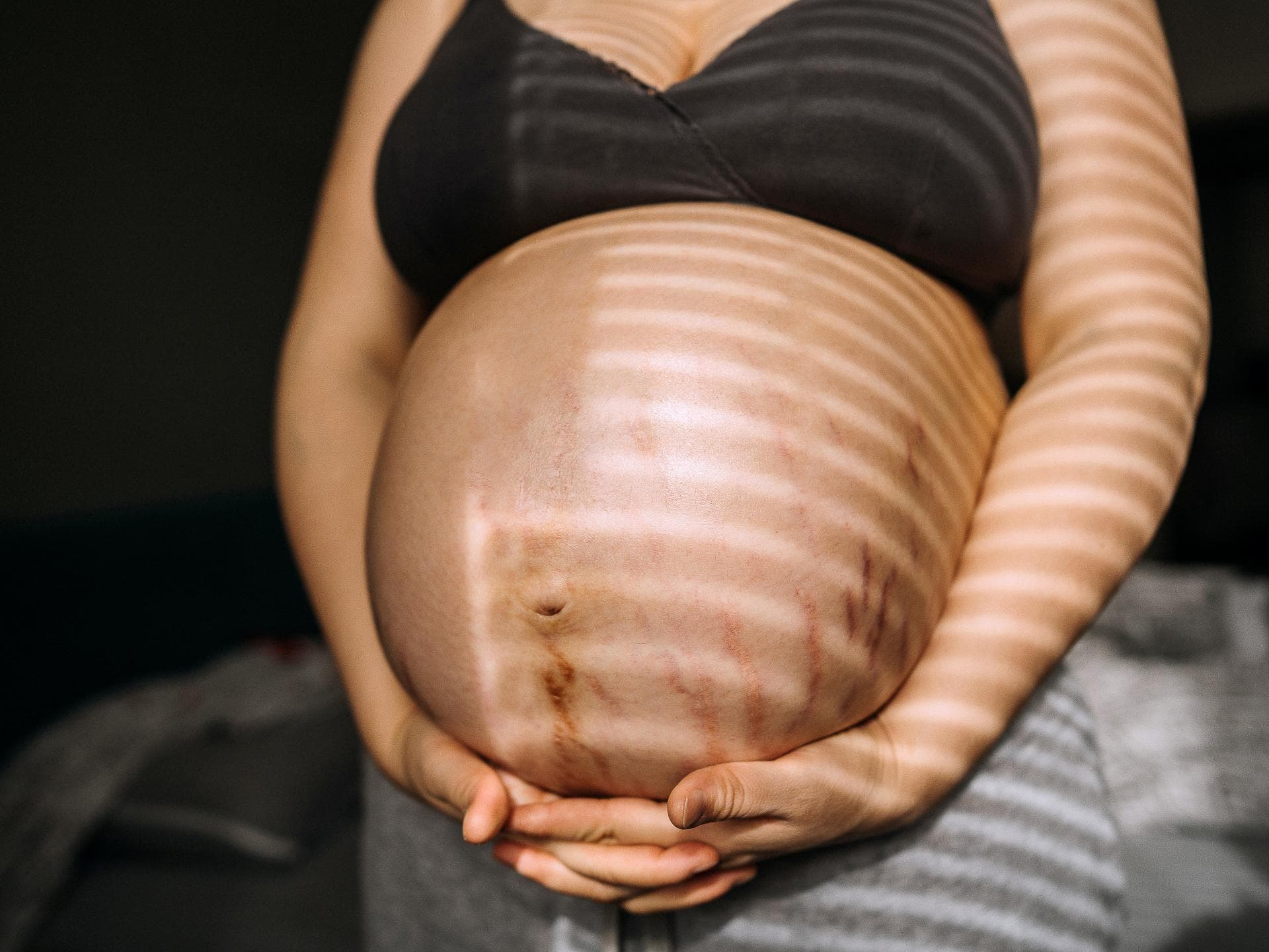 Schwangerschaftsstreifen Bauch