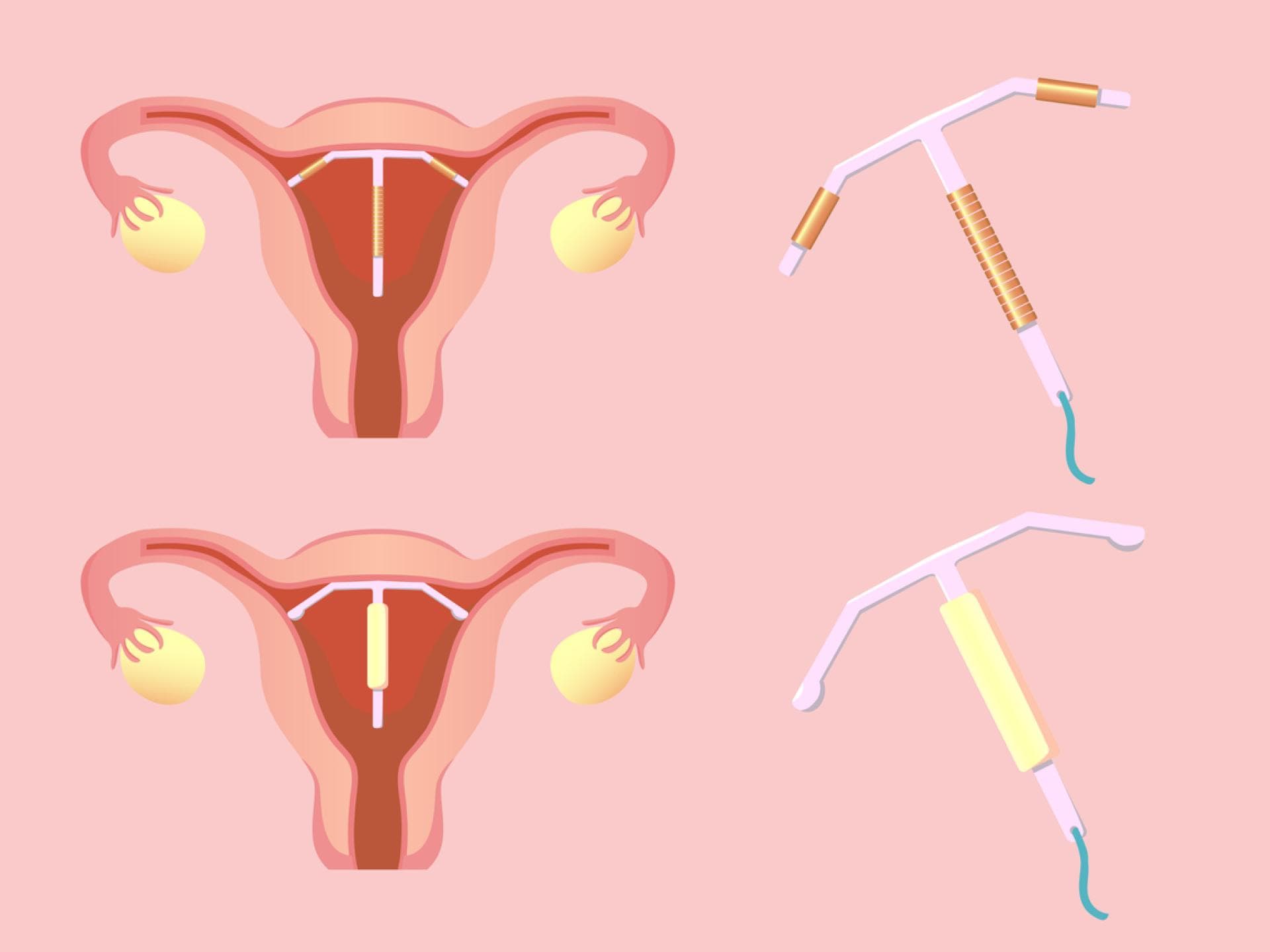 Hormonspirale vs. Kupferspirale