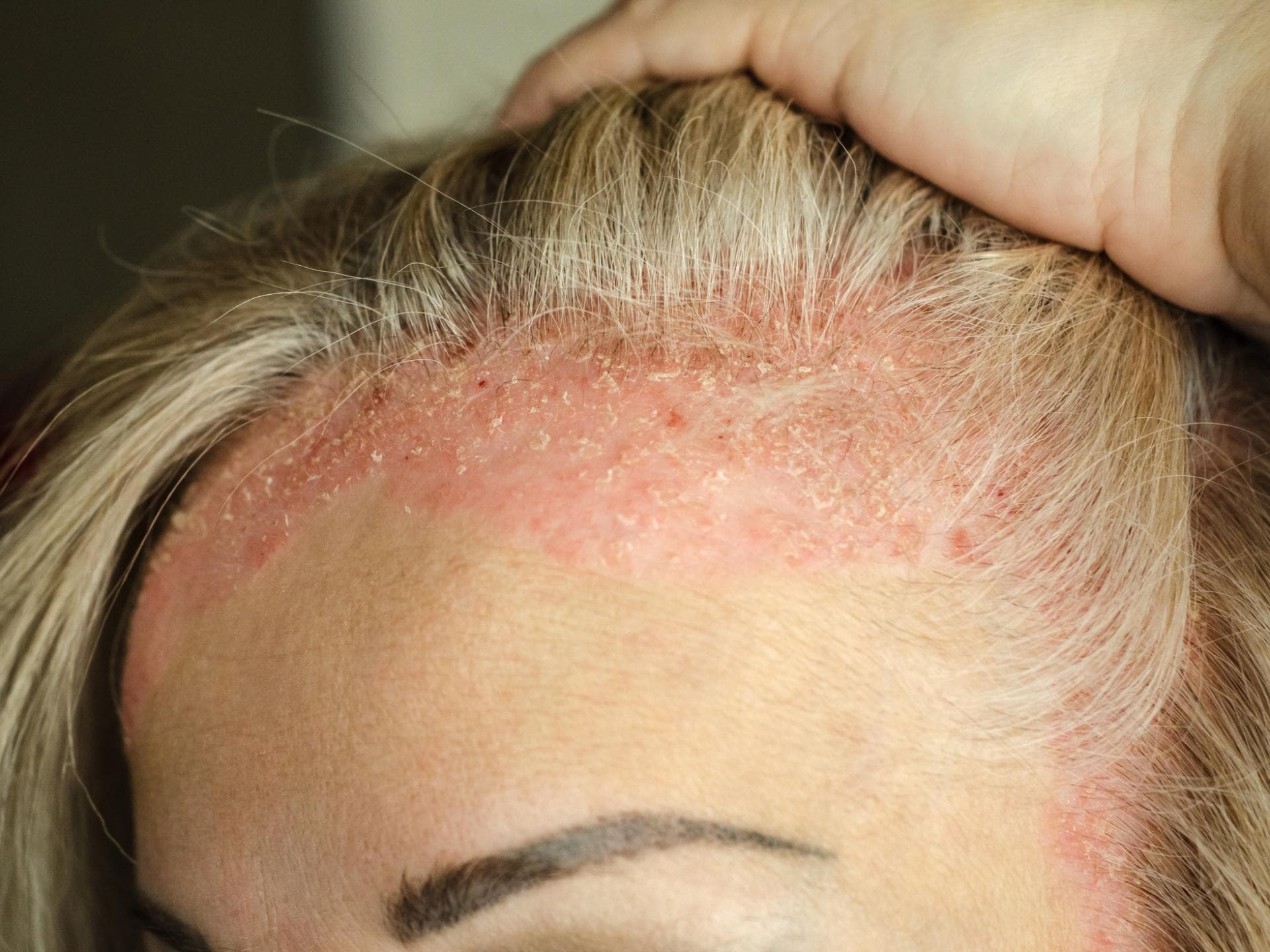 Schuppenflechte: Diese Dinge helfen wirklich gegen die Hauterkrankung Psoriasis Schuppenflechte auf Kopfhaut
