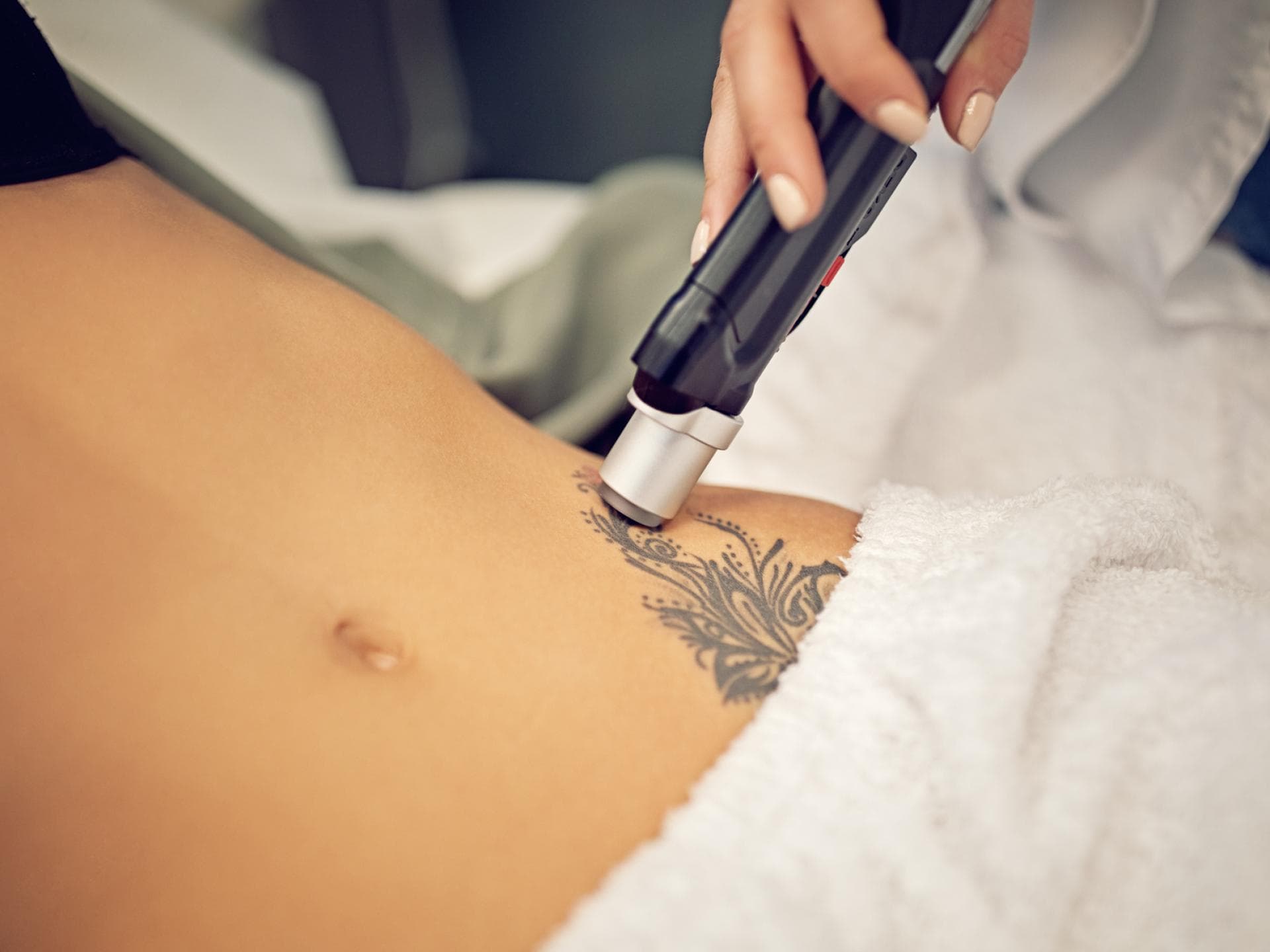 Tattoo am Bauch wird gelasert