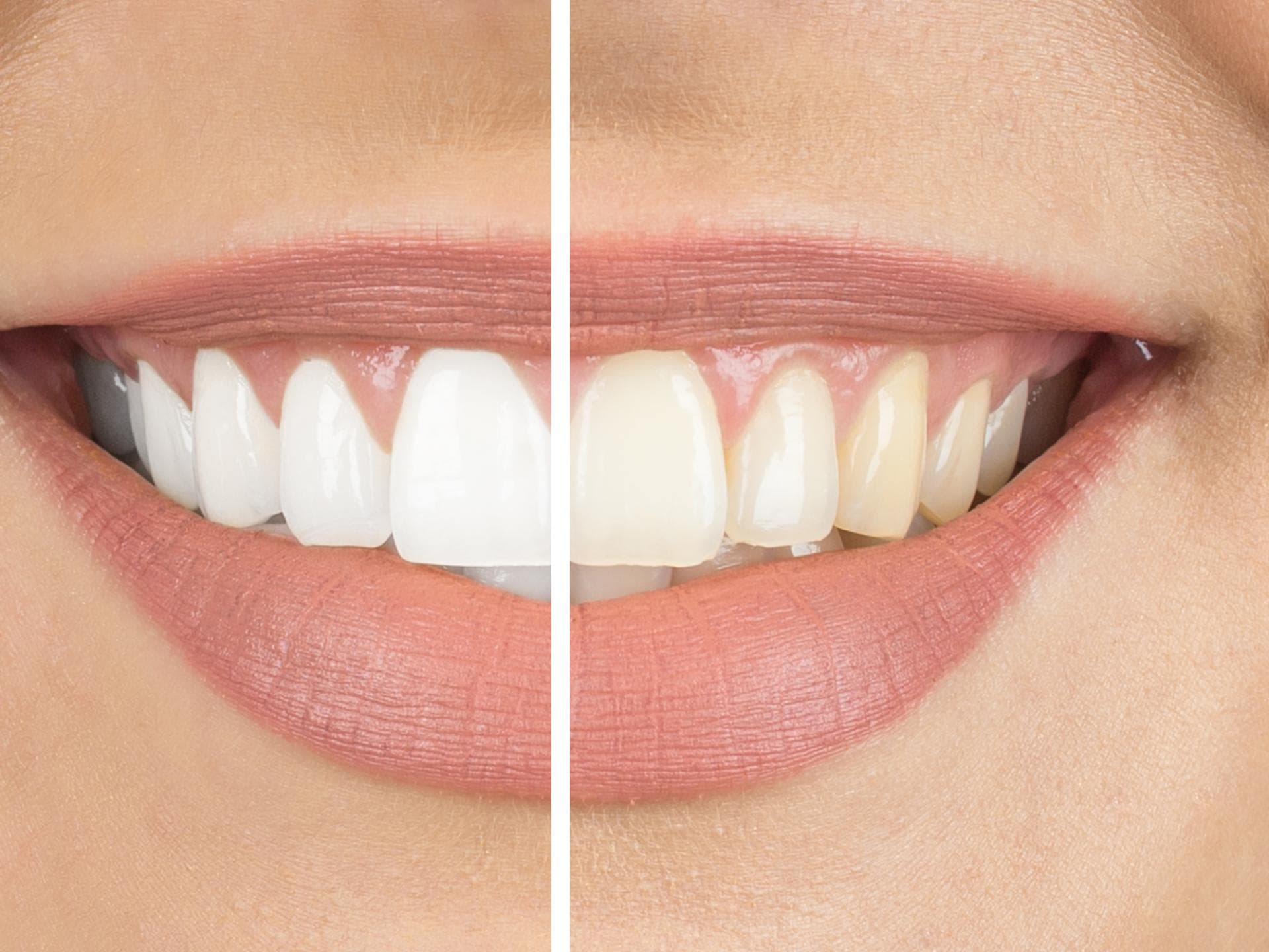 Bleaching: Vergleich vorher nachher