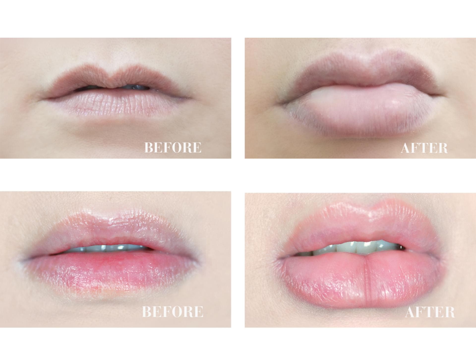 candylipz-vorher-nachher-1200 candylipz-vorher-nachher-1200