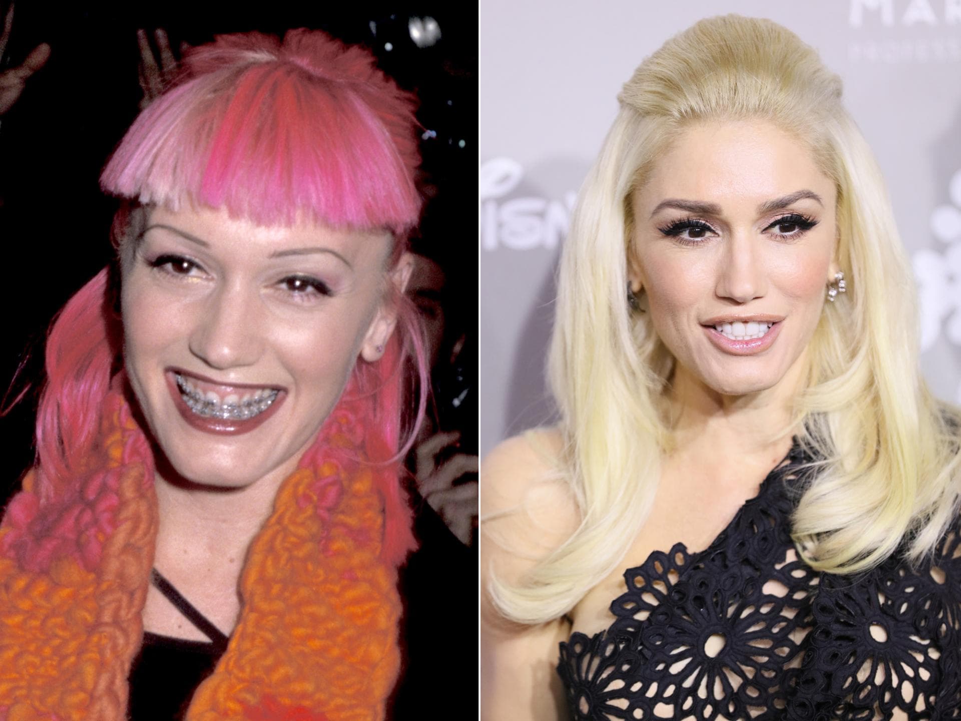 Gwen Stefani mit fester Zahnspange