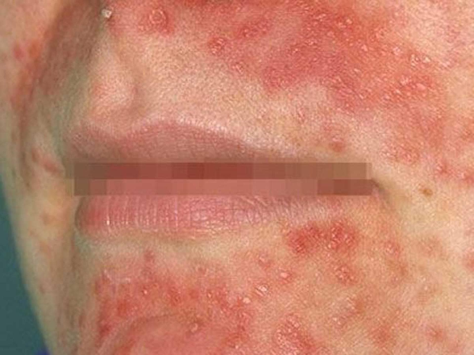 periorale-dermatitis periorale-dermatitis