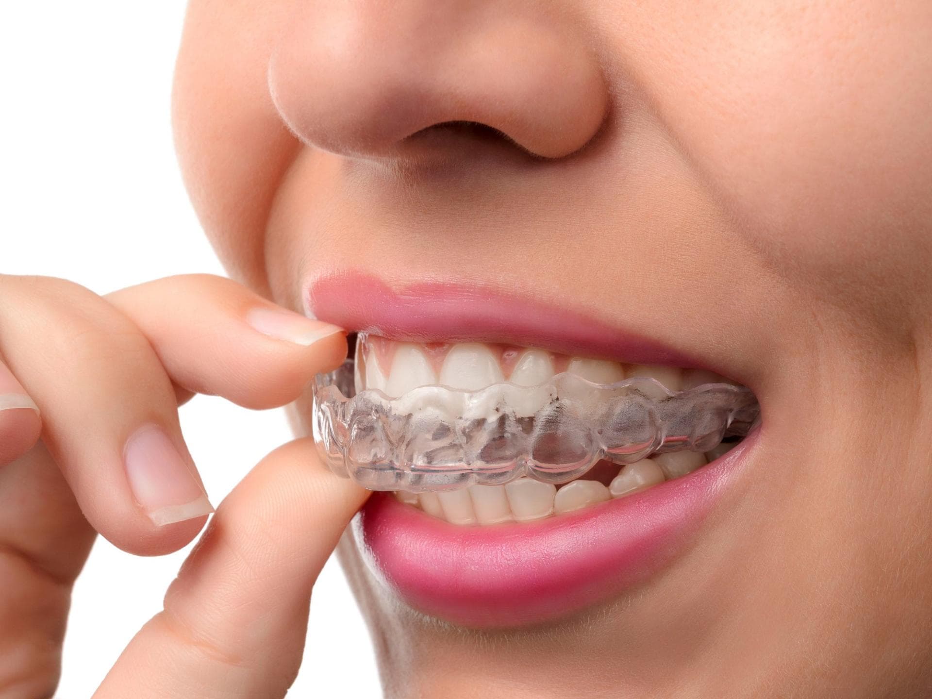 Invisalign