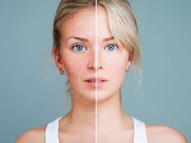 Junge Frau mit Rosacea und gesunder Haut, das Bild ist in der Mitte geteilt