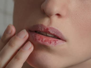Brennende Lippen