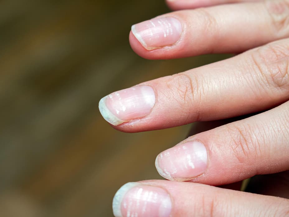 DAS haben Längsrillen in den Fingernägeln zu bedeuten und so wirst du sie wieder los