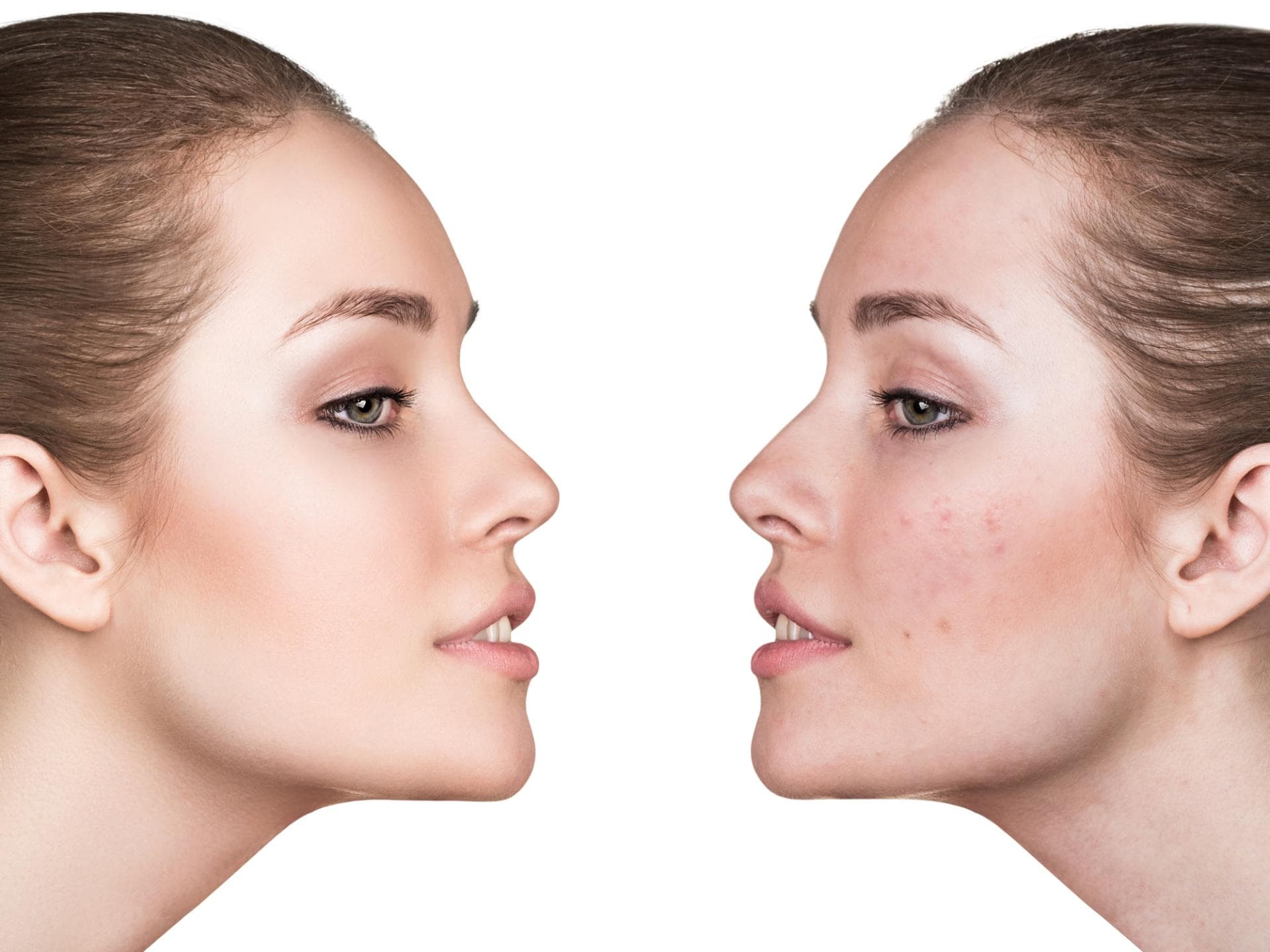 Periorale Dermatitis Was Hilft Gegen Die Hautkrankheit